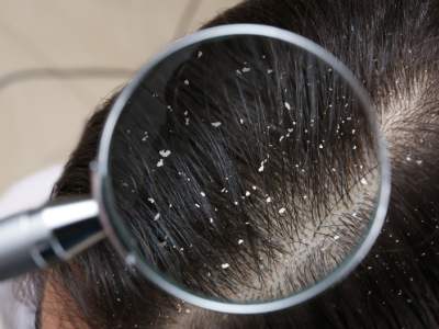 How To Get Rid Of Dandruff In Kids